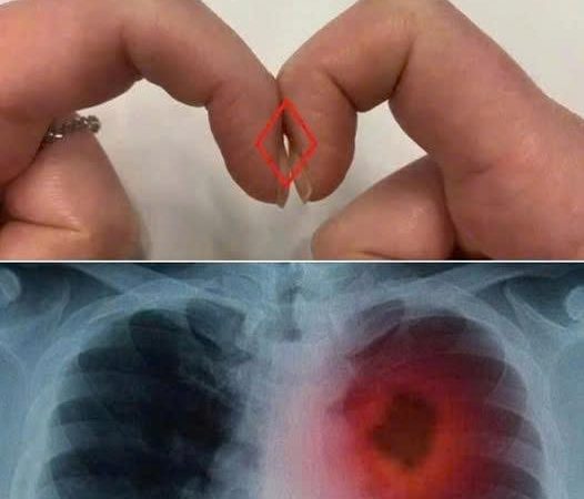 Đặt 2 đầu ngón tay trỏ sát nhau để biết mình bị ung thư phổi không: Cách thử nhanh BS cũng công nhận